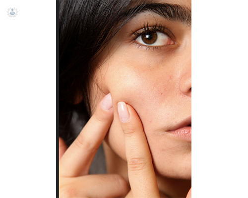 cicatrices-del-acne