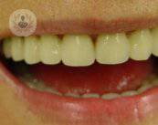 Recubrimiento de dientes con carillas o coronas