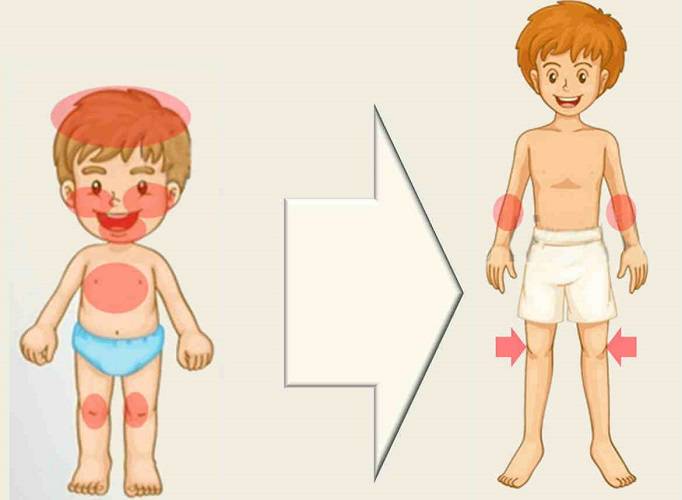 consecuencias-de-la-dermatitis-atopica imagen de artículo