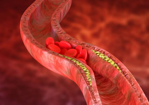 la-deteccion-temprana-de-la-aterosclerosis imagen de artículo