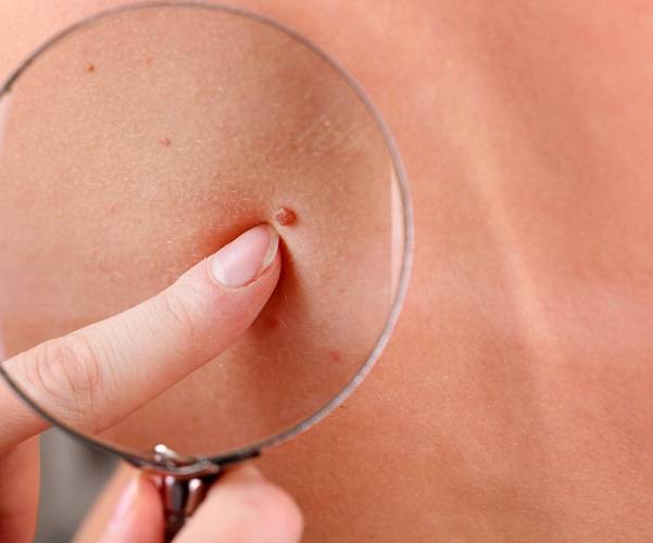 detecta-a-tiempo-un-melanoma-cutaneo imagen de artículo