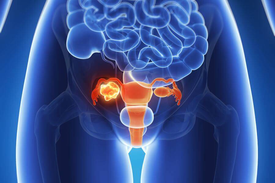 alternativas-para-miomas-uterinos imagen de artículo