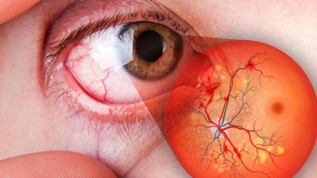 Afectaciones de la retinopatía diabética a la visión