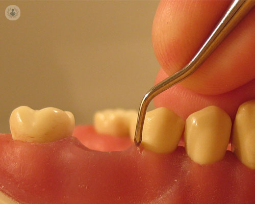 Síntomas y tratamiento de la periodontitis