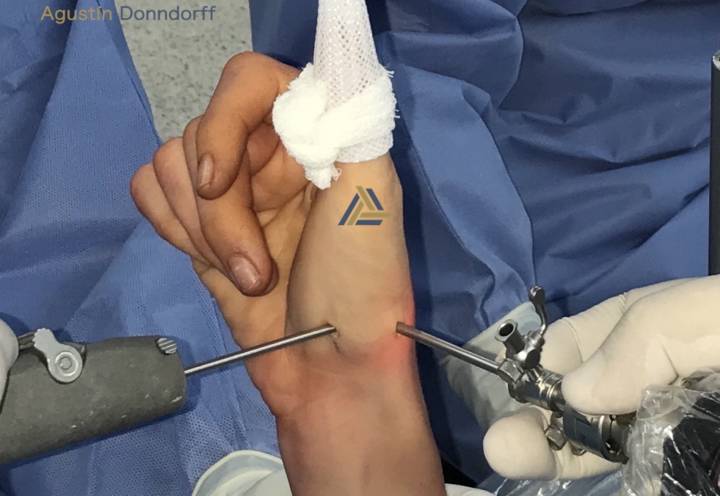 patologias-para-artroscopia-de-muneca imagen de artículo