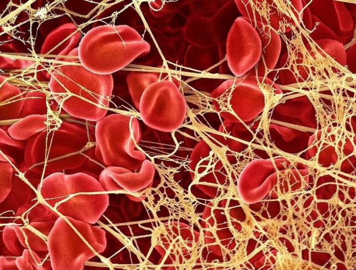 complicaciones-tromboticas-por-covid-19 imagen de artículo