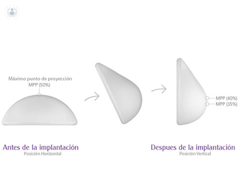 Implantes de pecho ergonómicos, la solución para un aspecto lo más natural