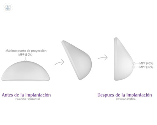 implantes-de-pecho-ergonomicos