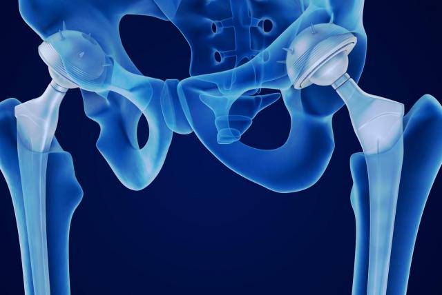 cirugia-de-cadera-resultados-previsibles imagen de artículo