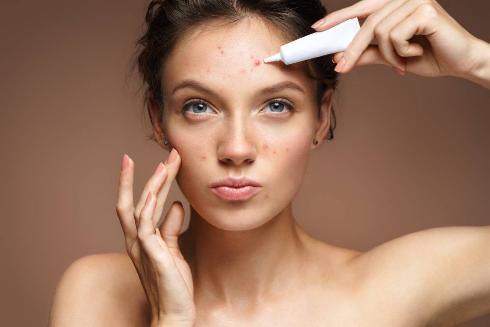 mitos-y-verdades-del-acne imagen de artículo