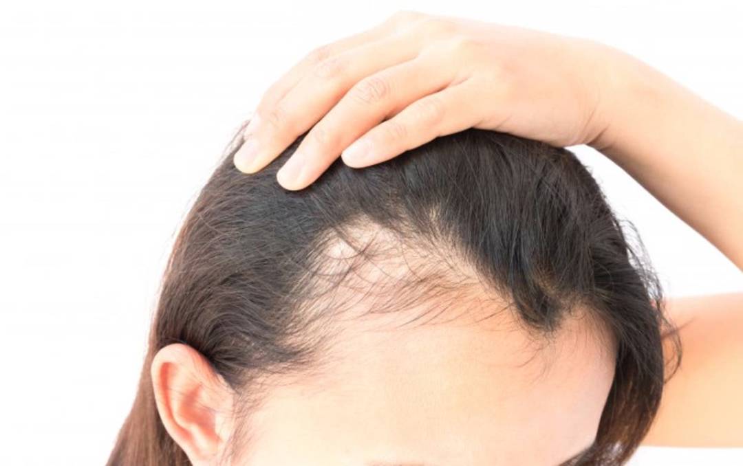 Pérdida de pelo: un posible efecto secundario del COVID-19