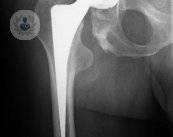 Cirugía de prótesis de cadera: causas, funcionamiento y consejos