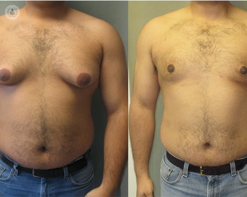 cirugia-para-la-ginecomastia imagen de artículo