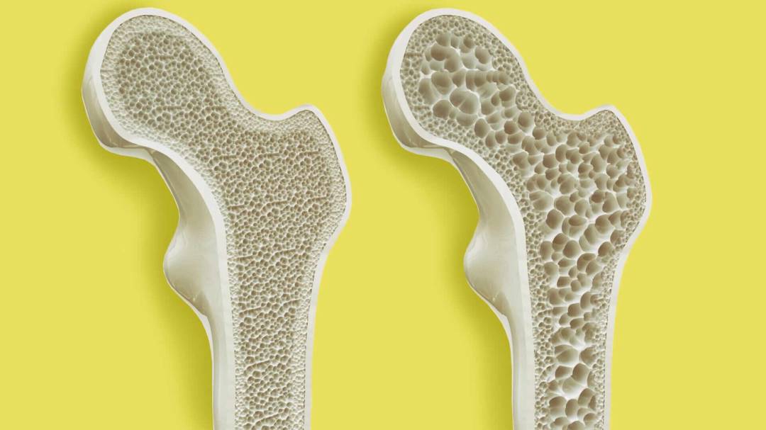 Osteoporosis: enfermedad ósea que disminuye la calidad y densidad de los huesos