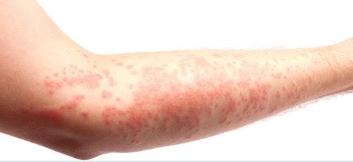 las-complicaciones-de-padecer-urticaria-cronica imagen de artículo