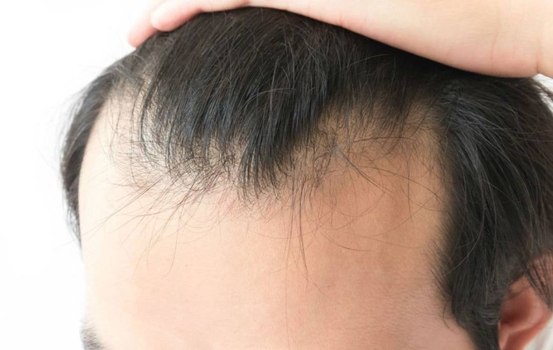 Alopecia: problema que tratan los Dermatólogos o Cirujanos Plásticos