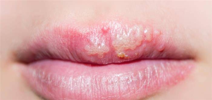 Cold sores: why does it occur and what should be done?
