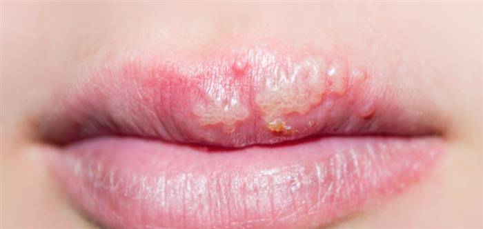 herpes-labial-por-que-ocurre-y-que-se-debe-hacer imagen de artículo