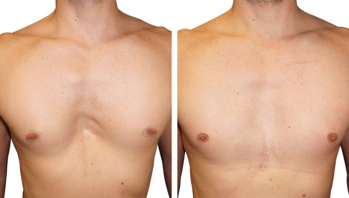 pectus-excavatum-pe-malformacion-toracica-mas-frecuente imagen de artículo
