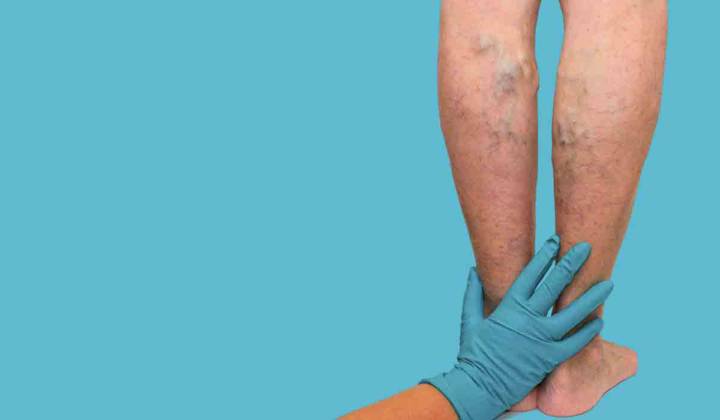 trombosis-venosa-profunda imagen de artículo