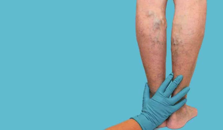 trombosis-venosa-profunda imagen de artículo