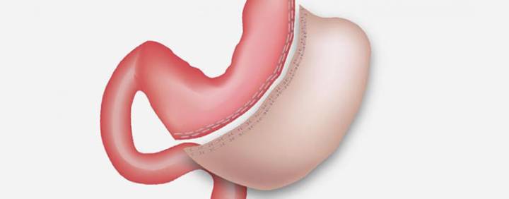 beneficios-de-la-manga-gastrica imagen de artículo