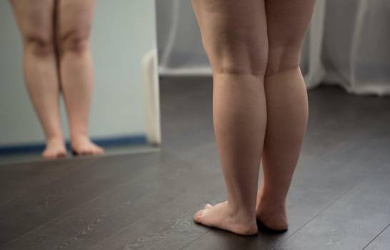 diferencia-entre-lipedema-linfedema-y-obesidad imagen de artículo