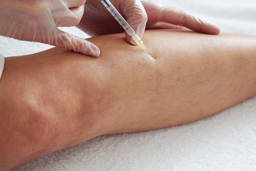 Non-surgical treatment for varicose veins