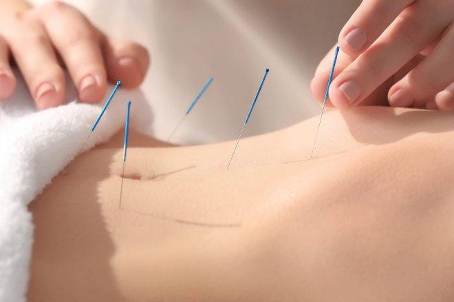 como-saber-si-la-acupuntura-es-para-ti imagen de artículo