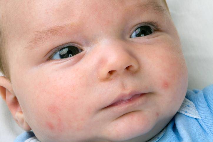los-bebes-pueden-tener-acne imagen de artículo