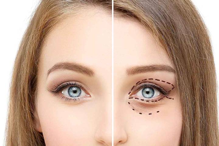 las-selfies-pusieron-de-moda-las-cirugias-de-parpados imagen de artículo