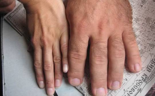 acromegalia-una-enfermedad-rara-que-se-conmemora-hoy imagen de artículo