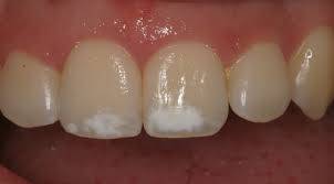 ¿Qué significa tener manchas blancas en los dientes?