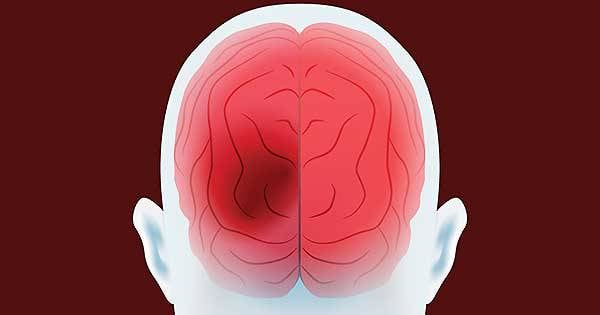 se-pueden-prevenir-los-acv imagen de artículo