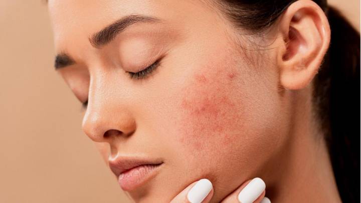 tratamiento-farmacologico-para-acne imagen de artículo