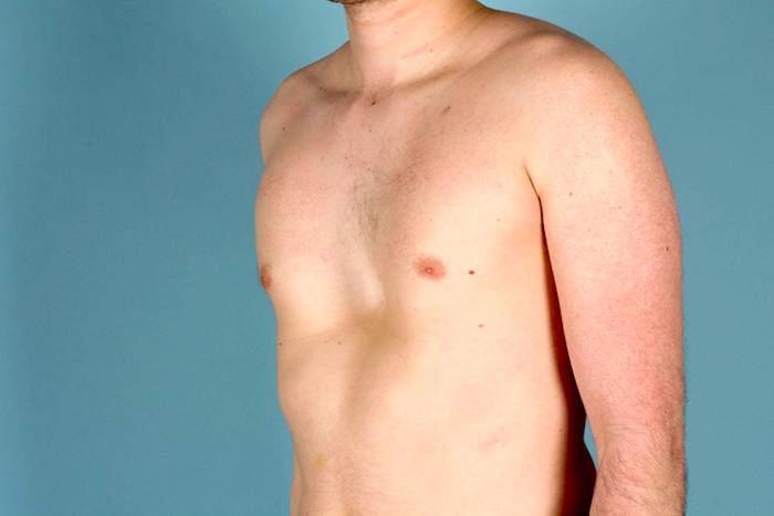pectus-excavatum-y-pectus-carinatum-causas-y-tratamiento imagen de artículo