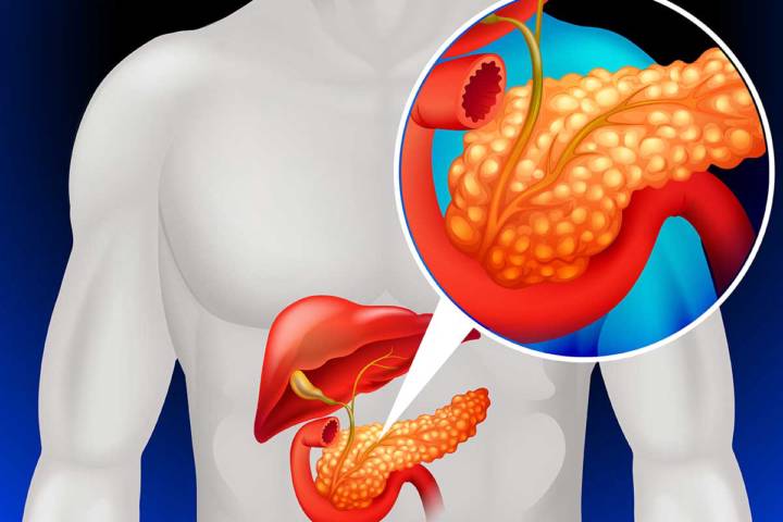 vias-de-abordaje-para-enfermedades-pancreaticas imagen de artículo