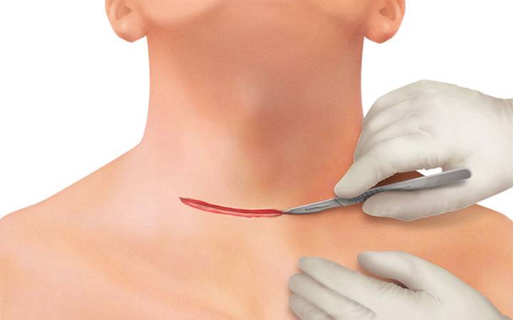 tiroides-diagnostico-y-tratamiento-de-tumores-tiroideos imagen de artículo