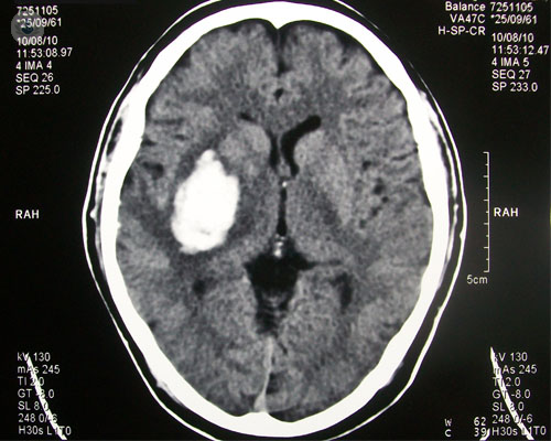 tumor-cerebral