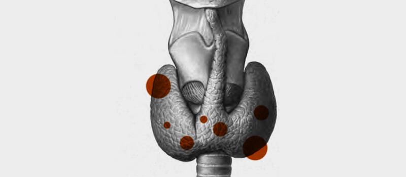 Tiroides: sobre la cirugía y el posoperatorio