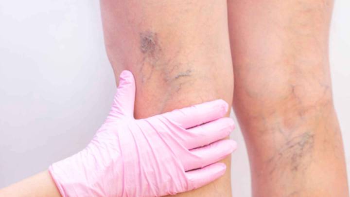 se-puede-prevenir-las-varices imagen de artículo