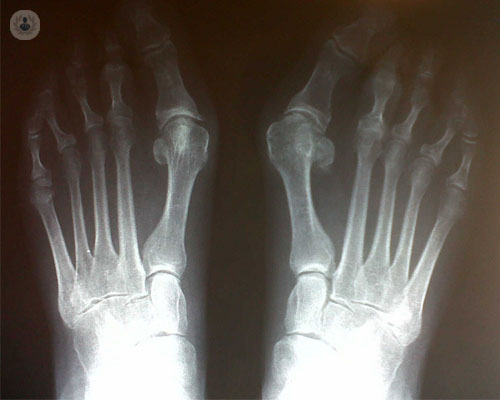 cuando-recurrir-a-la-cirugia-de-juanete imagen de artículo