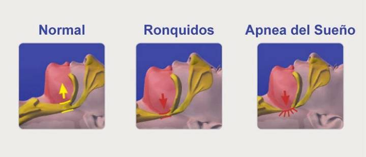 apneas-del-sueno imagen de artículo