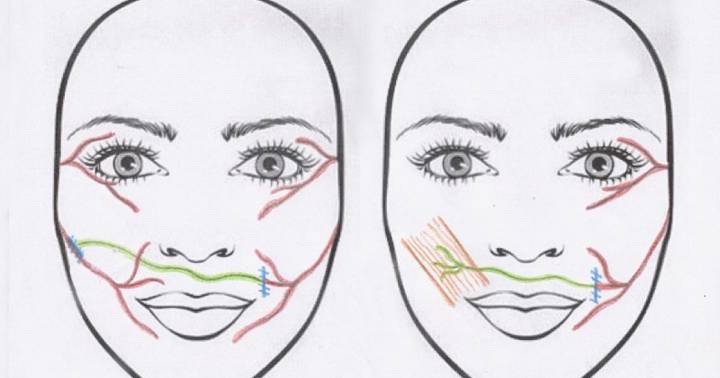 sindrome-de-ramsay-hunt imagen de artículo