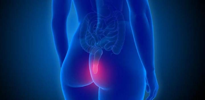 pph--cirugia-para-hemorroides- imagen de artículo