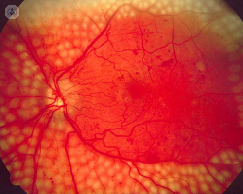 Cómo saber si tengo retinopatía diabética