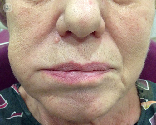 absceso-flemon-dental