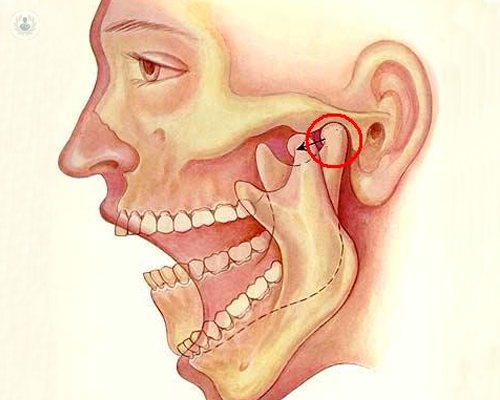 cirugia-ortognatica-guias-miniplacas-personalizadas