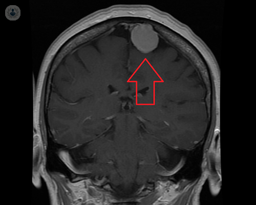 meningioma