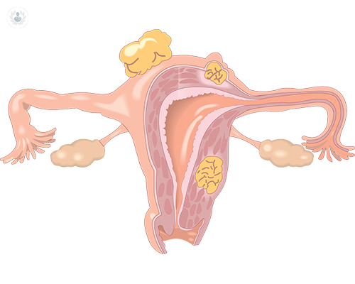 mioma-uterino